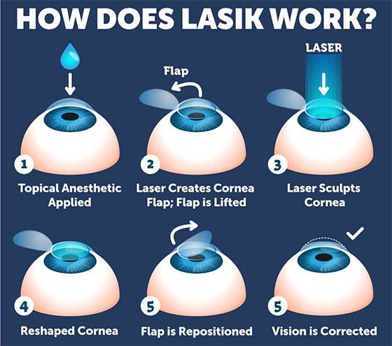 LASIK-Diagram