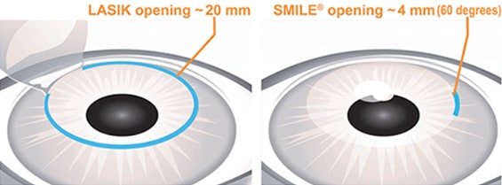 lasik-vs-smile-eye-procedure