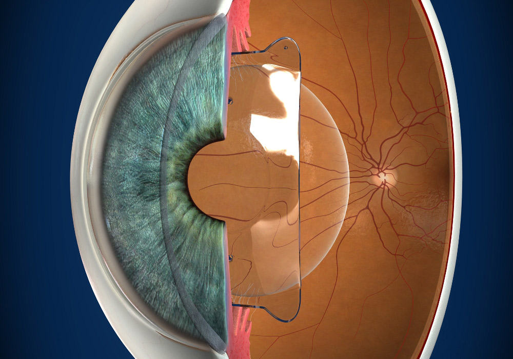 Implantable Collamer Lens Surgery