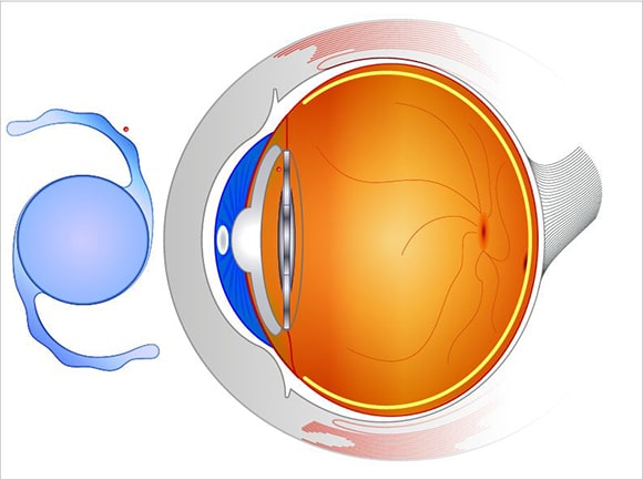 inter-ocular-lense
