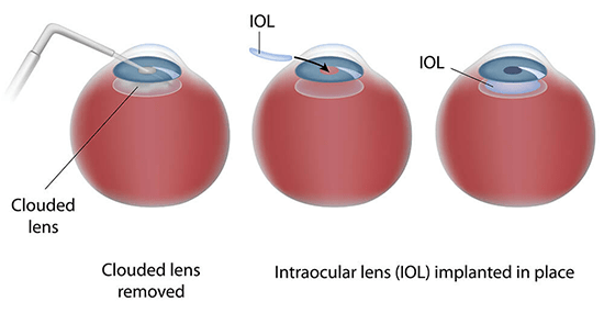 intraocular-lens