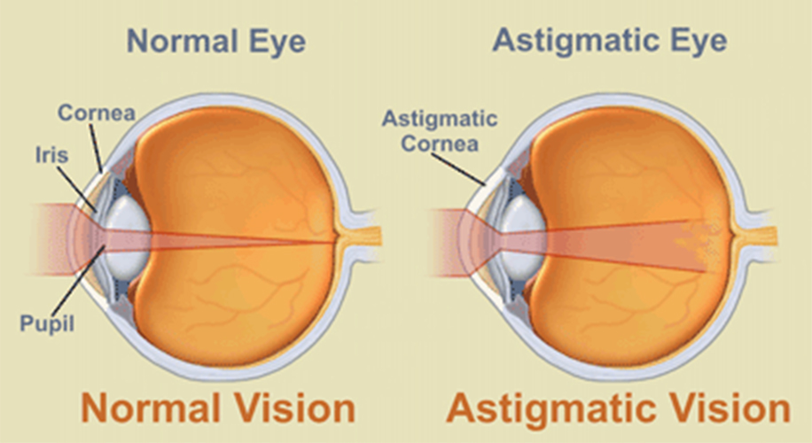 Can-You-Get-Lasik-with-Astigmatism